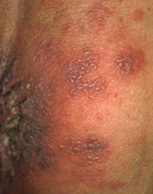 ヘルペス お 尻 帯状疱疹でおしりが痛む時の対処法は？